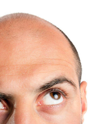 Łysienie trakcyjne – Ciasne upięcia i warkoczyki a bezpośrednie zagrożenie dla włosów Łysienie trakcyjne